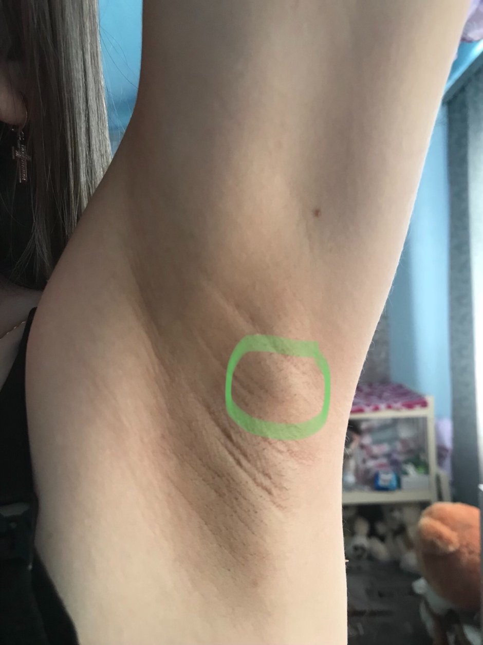 Подмышечные лимфатические узлы анатомия