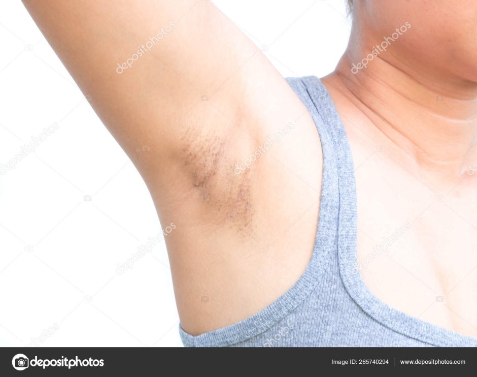 Воспаление в подмышечной впадине